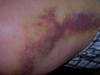 bruised.jpg